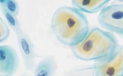 Diagnostic cytologic staining of Pap smear sample