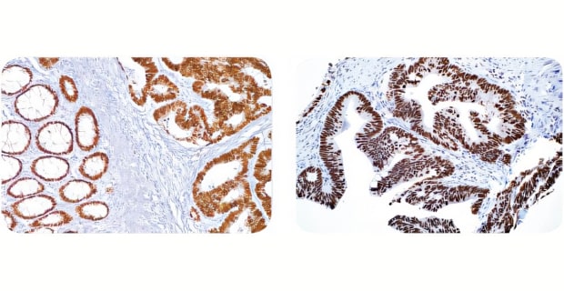 Diagnostic immunohistochemical staining 结肠癌的Cell Marque™ IVD抗体染色
