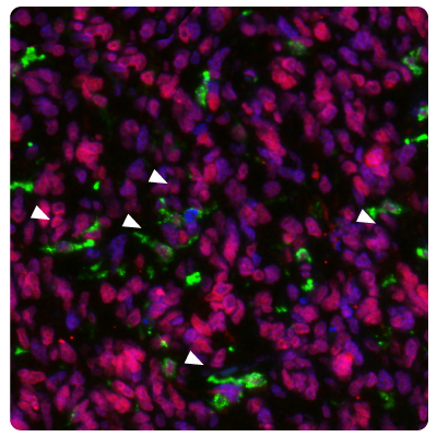 METTL21B Expression in Glioblastoma Tumor Cells Image of IHC-IF staining of glioblastoma samples using Anti-HLA-DRA monoclonal and Anti-METTL21B polyclonal (Product No. HPA043020) antibodies showing HLA-DRA positive activated microglia.