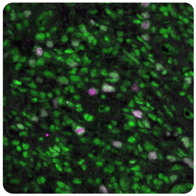 EZH2 and SGO2 Expression in Glioblastoma Multiplexed IHC-IF staining of glioblastoma samples using Anti-EZH2 monoclonal (Product No. AMAb91750) and Anti-SGO2 polyclonal (Product No. HPA035163) antibodies.