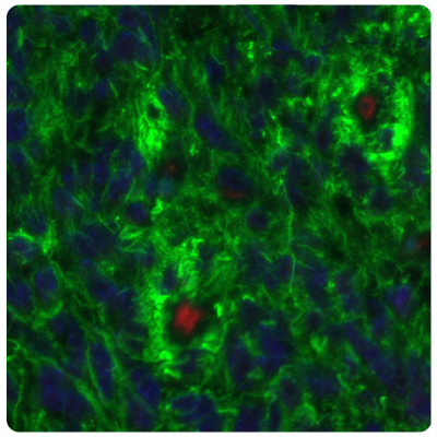SALL4 Upregulation in Glioma Samples Multiplexed IHC-IF staining of glioblastoma samples using Anti-SALL4 monoclonal (Product No. AMAb91769) and Anti-PTEN monoclonal (Product No. AMAb91736) antibodies showing SALL4 upregulation.