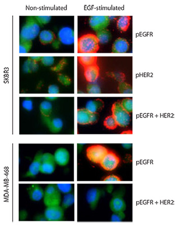 Two breast cancer cell lines, SKBR3 and MDA-MB-468, are assayed with Duolink before and after EGF treatment for three targets: pEGFR alone, pHER2 alone, and the complex pEGFR-HER2. Red: PLA signals. Green: Sample autofluorescence (to visualize the cell morphology). Blue: nuclei (DAPI). Images were taken pair wise with the same exposure time of EGF-stimulated and non-stimulated samples for each assayed analyte. Two breast cancer cell lines, SKBR3 and MDA-MB-468, are assayed with Duolink before and after EGF treatment for three targets: pEGFR alone, pHER2 alone, and the complex pEGFR-HER2. Red: PLA signals. Green: Sample autofluorescence (to visualize the cell morphology). Blue: nuclei (DAPI). Images were taken pair wise with the same exposure time of EGF-stimulated and non-stimulated samples for each assayed analyte.