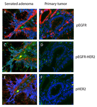 Duolink assay of HER-family dimerization and activation in colon tissue samples. Both samples contained high levels of pEGFR (A,B) but only the serrated adenoma showed high levels of pEGFR‑HER2 complexes (C,D) and of pHER2 (E,F). Red: PLA signals. Green: Sample autofluorescence (to visualize the cell morphology). Blue: nuclei (DAPI). Duolink assay of HER-family dimerization and activation in colon tissue samples. Both samples contained high levels of pEGFR (A,B) but only the serrated adenoma showed high levels of pEGFR‑HER2 complexes (C,D) and of pHER2 (E,F). Red: PLA signals. Green: Sample autofluorescence (to visualize the cell morphology). Blue: nuclei (DAPI).