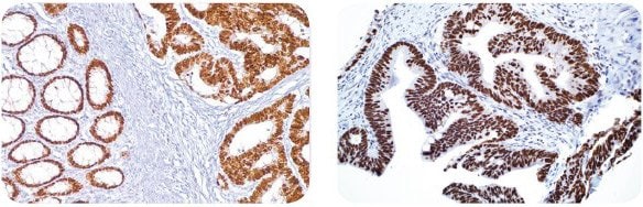 Cell Marque™ IVD antibody staining of colon carcinoma