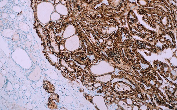 IHC staining of papillary thyroid carcinoma with Cell Marque™ antibody TROP2 (EP431) and counterstain