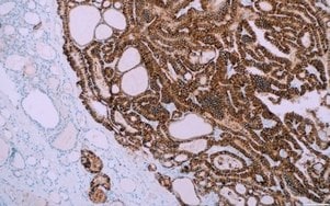 IHC staining of clinical tissue with a Cell Marque™ TROP2 antibody