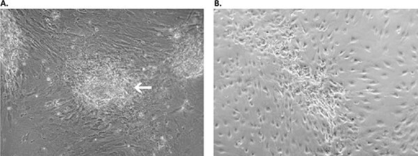 primary-cancer-culture-system Primary culture derived from an invasive adenocarcinoma with the Primary Cancer Culture System