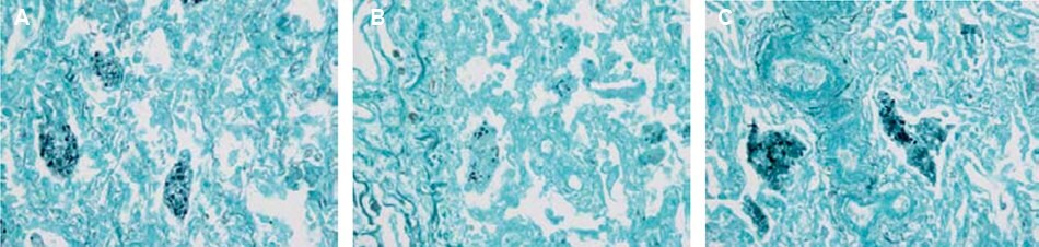 Micrographs GMS-stained <i>Pneumocystis jirovecii</i> infected lung tissue 