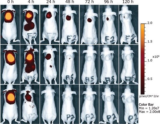 Intratumoral injection of siRNA polyplexes