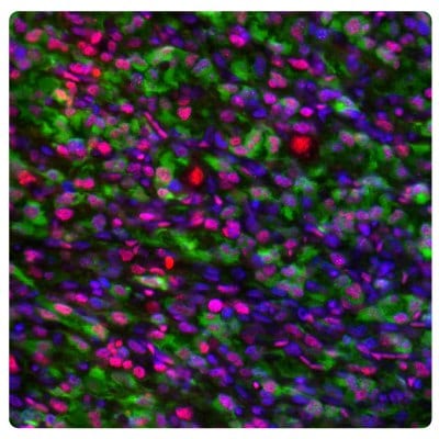 Multiplexed IHC-IF staining of anaplastic oligodendroglioma showing ATRX and IDH1 immunoreactivity in tumor cells. Anti-ATRX antibody (Product No. AMAB90784) and Anti-IDH1 antibody (Product No. AMAB90578) were used.