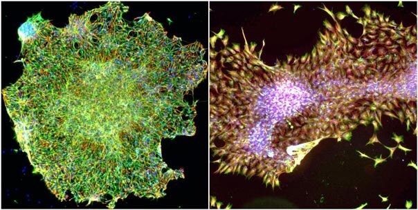  Feeder free hESC's were transduced using the above protocol, and then imaged by fluorescence microscopy. Nuclei were stained (blue) to indicated cell position and viability, and beta-III-tubulin (green) was detected via immunofluorescence (IF) microscopy. In addition, nestin levels (red) were also detected by IF microscopy. Left: Cells transduced with shRNA targeting RhoA resulting in differentiation into neural pre-cursors. Right: Cells transduced with non-target viral control resulting in normal stem cell colonies. Membranous staining by beta-III-tubulin and spindle morphology indicate neuronal differentiation in the RhoA shRNA treated cells. Finally, the non-target treated cells maintained strong cytoplasmic nestin staining.