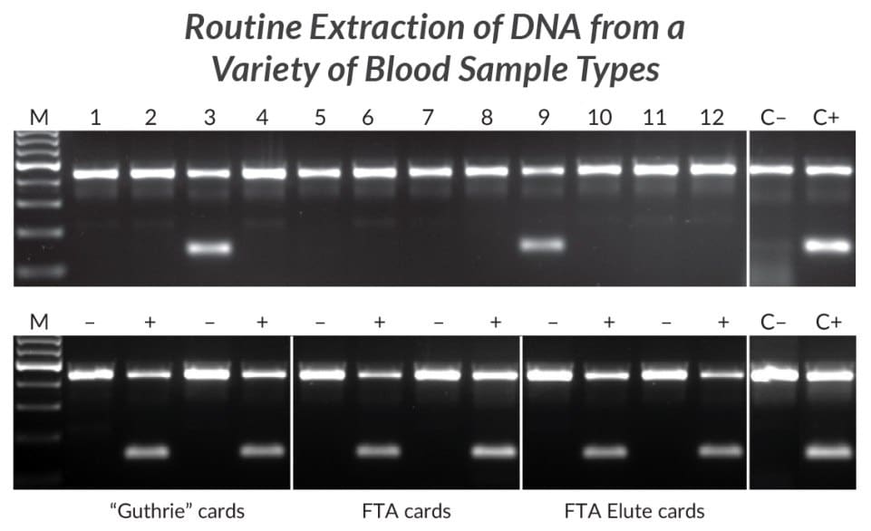 提取和扩增来自不同血液样本的DNA用于HLA-B*27等位基因的检测。