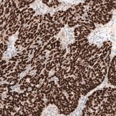 Anti-WT1 antibody produced in mouse Prestige Antibodies® Powered by Atlas Antibodies, clone CL13170, purified by using Protein A, buffered aqueous glycerol solution